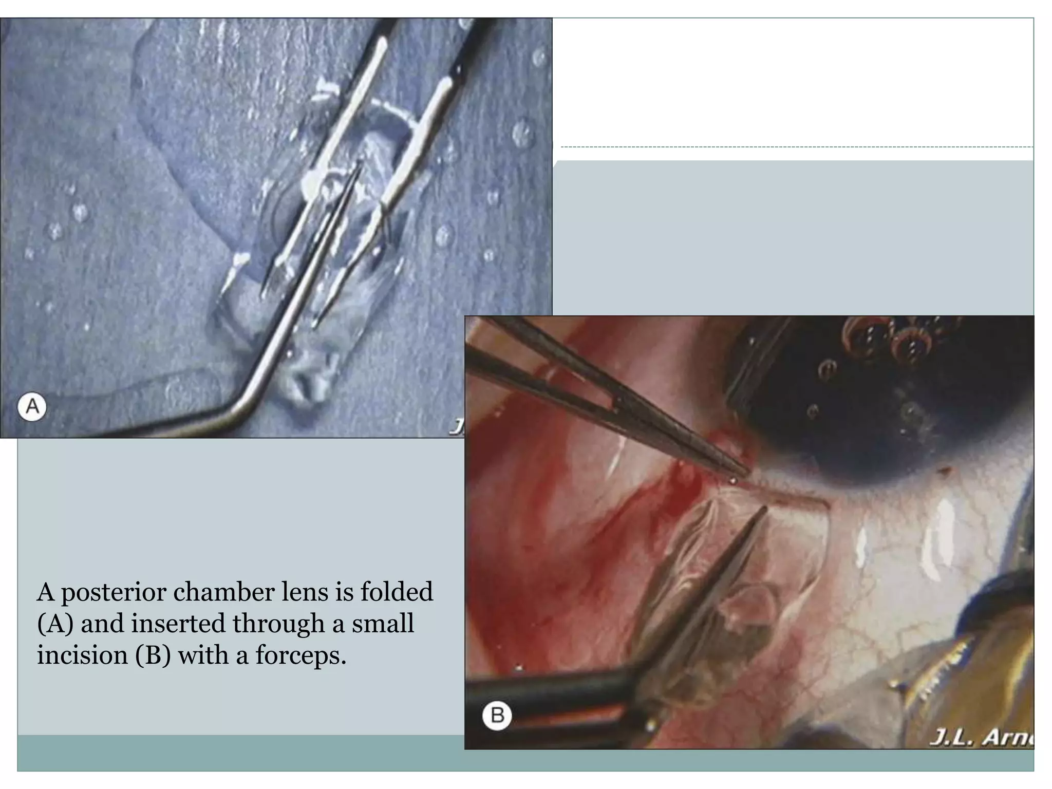 A posterior chamber lens is folded
(A) and inserted through a small
incision (B) with a forceps.
 