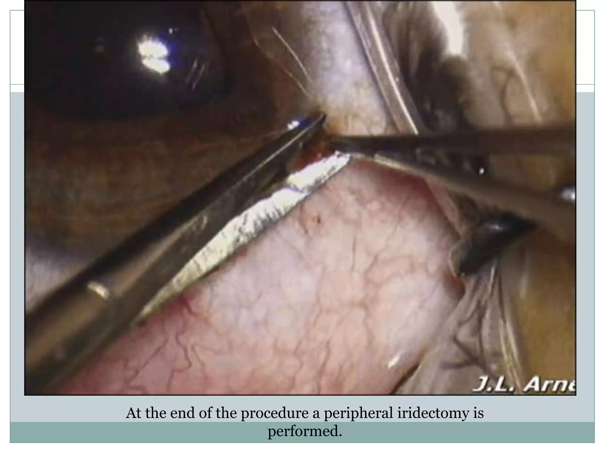 At the end of the procedure a peripheral iridectomy is
performed.
 