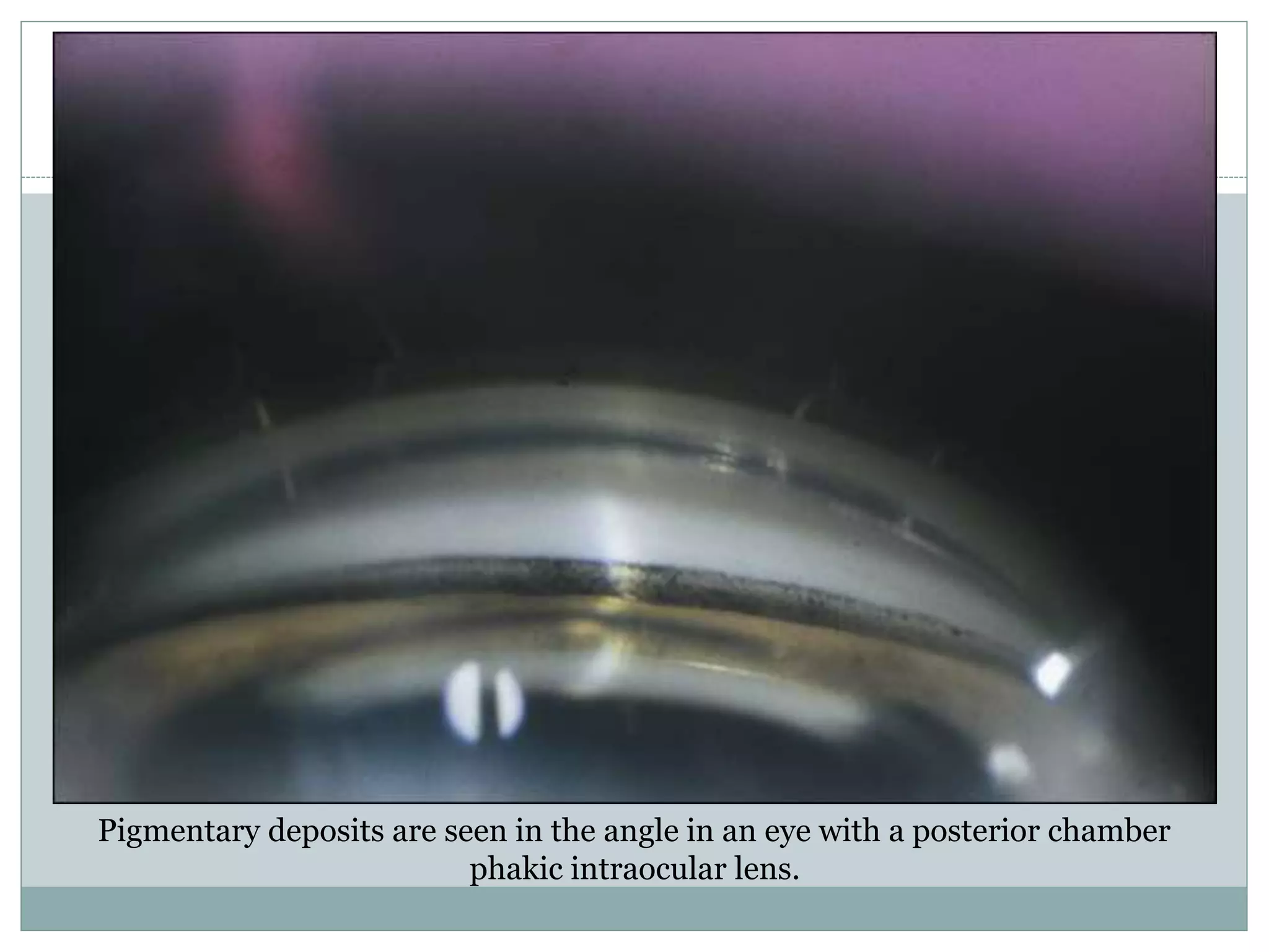 Pigmentary deposits are seen in the angle in an eye with a posterior chamber
phakic intraocular lens.
 