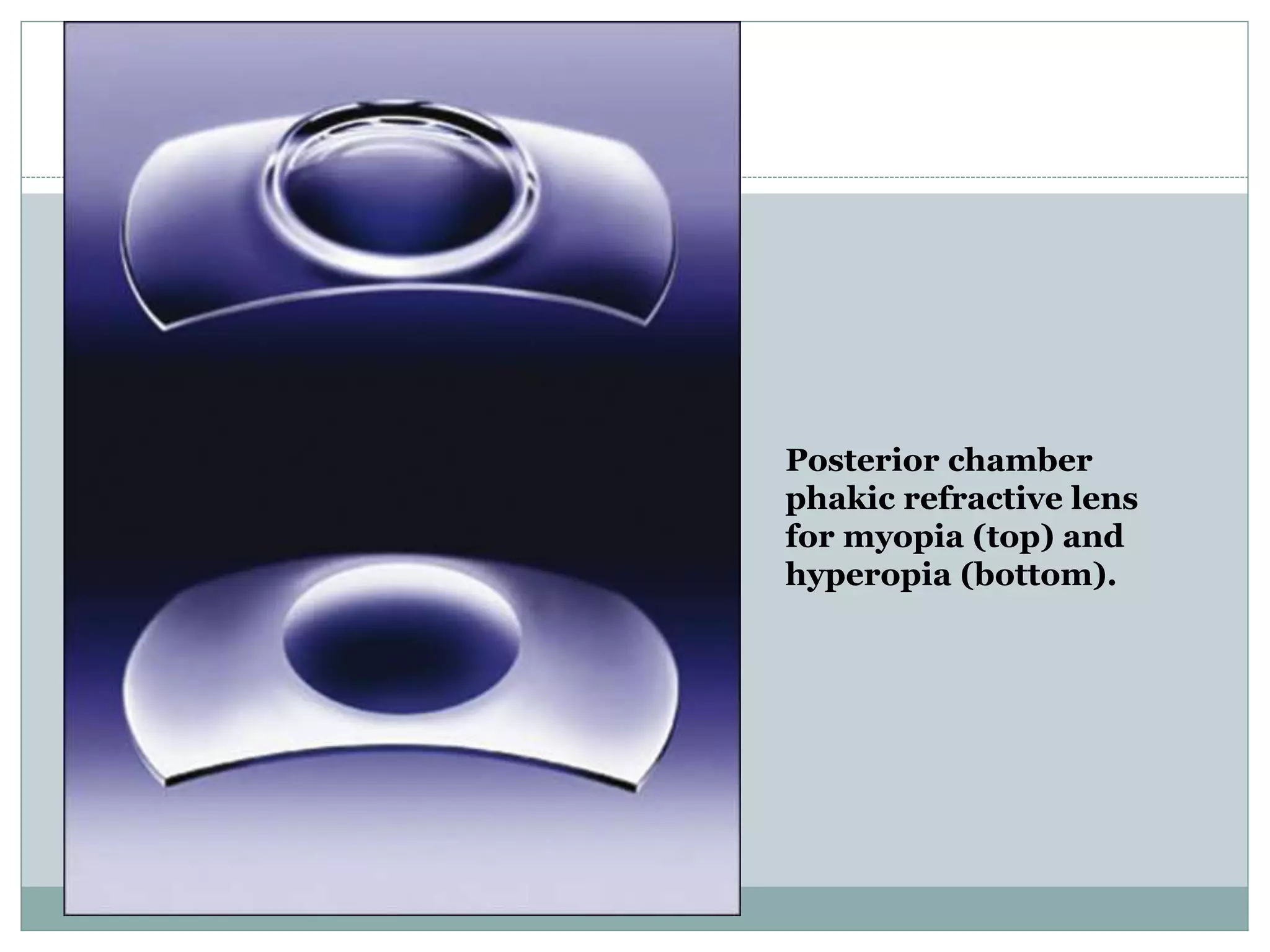 Posterior chamber
phakic refractive lens
for myopia (top) and
hyperopia (bottom).
 