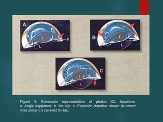 Figure 3: Schematic representation of phakic IOL locations:
a. Angle supported. b. Iris clip. c. Posterior chamber shown in dotted
lines since it is covered by Iris.
 