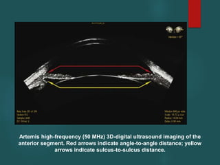 Artemis high-frequency (50 MHz) 3D-digital ultrasound imaging of the
anterior segment. Red arrows indicate angle-to-angle distance; yellow
arrows indicate sulcus-to-sulcus distance.
 