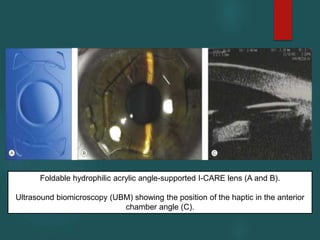 Foldable hydrophilic acrylic angle-supported I-CARE lens (A and B).
Ultrasound biomicroscopy (UBM) showing the position of the haptic in the anterior
chamber angle (C).
 