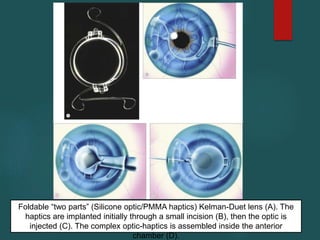 Foldable “two parts” (Silicone optic/PMMA haptics) Kelman-Duet lens (A). The
haptics are implanted initially through a small incision (B), then the optic is
injected (C). The complex optic-haptics is assembled inside the anterior
chamber (D).
 