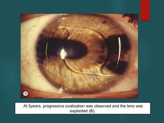 At 5years, progressive ovalization was observed and the lens was
explanted (B).
 