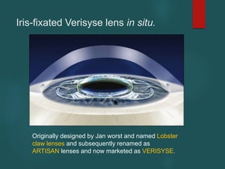 Iris-fixated Verisyse lens in situ.
Originally designed by Jan worst and named Lobster
claw lenses and subsequently renamed as
ARTISAN lenses and now marketed as VERISYSE.
 