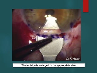 The incision is enlarged to the appropriate size.
 