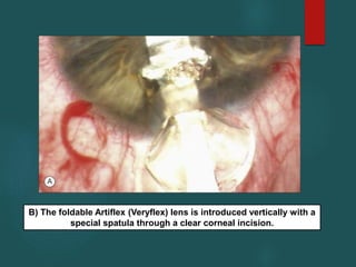 B) The foldable Artiflex (Veryflex) lens is introduced vertically with a
special spatula through a clear corneal incision.
 