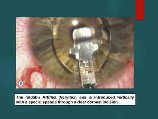 The foldable Artiflex (Veryflex) lens is introduced vertically
with a special spatula through a clear corneal incision.
 