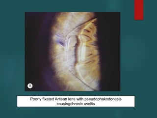 Poorly fixated Artisan lens with pseudophakodonesis
causingchronic uveitis
 