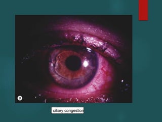 ciliary congestion
 
