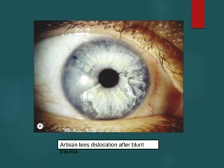 Artisan lens dislocation after blunt
trauma
 