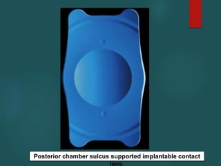 Posterior chamber sulcus supported implantable contact
lens.
 