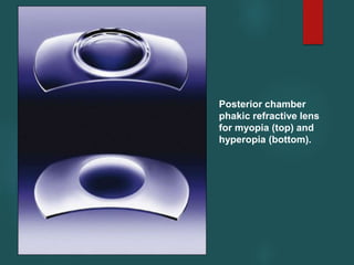 Posterior chamber
phakic refractive lens
for myopia (top) and
hyperopia (bottom).
 