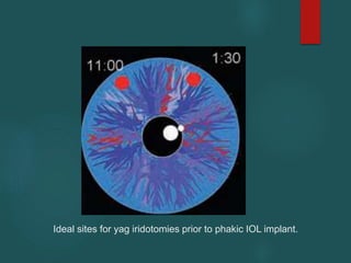 Ideal sites for yag iridotomies prior to phakic IOL implant.
 