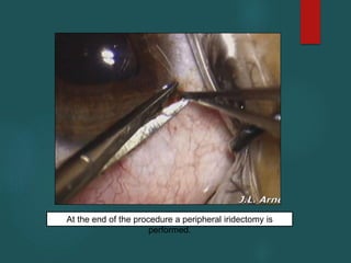 At the end of the procedure a peripheral iridectomy is
performed.
 