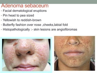 Adenoma sebaceum
• Facial dematological eruptions
• Pin head to pea sized
• Yellowish to reddish-brown
• Butterfly fashion over nose ,cheeks,labial fold
• Histopathologically :- skin lesions are angiofibromas
 