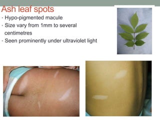 Ash leaf spots
• Hypo-pigmented macule
• Size vary from 1mm to several
centimetres
• Seen prominently under ultraviolet light
 