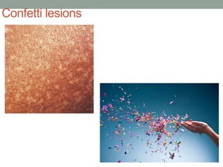Confetti lesions
 