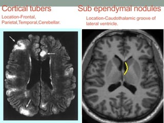 Cortical tubers Sub ependymal nodules
Location-Frontal,
Parietal,Temporal,Cerebellar.
Location-Caudothalamic groove of
lateral ventricle.
 