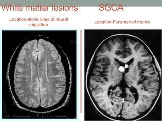 White matter lesions SGCA
Location-alone lines of neural
migration
Location-Foramen of monro
 