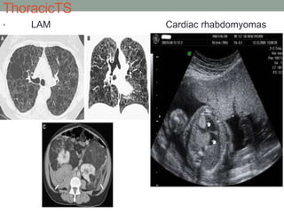 ThoracicTS
• LAM Cardiac rhabdomyomas
 