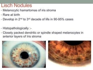 Lisch Nodules
• Melanocytic hamartomas of iris stroma
• Rare at birth
• Develop in 2nd to 3rd decade of life in 90-95% cases
• Histopathologically :-
• Closely packed dendritic or spindle shaped melanocytes in
anterior layers of Iris stroma
 