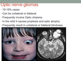 Optic nerve gliomas
• 10-15% cases
• Can be unilateral or bilateral
• Frequently involve Optic chiasma
• In the orbit it causes proptosis and optic atrophy
• Frequently result in unilateral or bilateral blindness
 