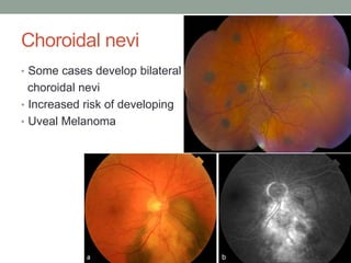 Choroidal nevi
• Some cases develop bilateral
choroidal nevi
• Increased risk of developing
• Uveal Melanoma
 
