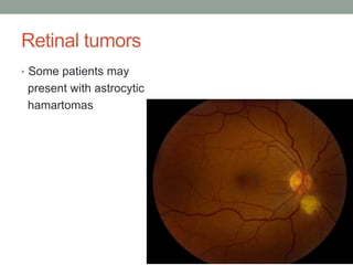 Retinal tumors
• Some patients may
present with astrocytic
hamartomas
 