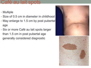 Café au lait spots
• Multiple
• Size of 0.5 cm in diameter in childhood
• May enlarge to 1.5 cm by post pubertal
age
• Six or more Café au lait spots larger
than 1.5 cm in post pubertal age
generally considered diagnostic
 