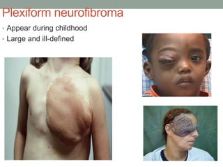 Plexiform neurofibroma
• Appear during childhood
• Large and ill-defined
 