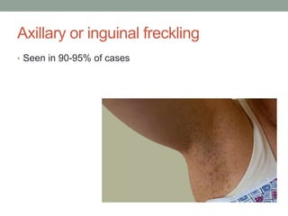 Axillary or inguinal freckling
• Seen in 90-95% of cases
 