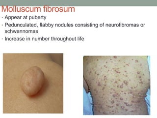 Molluscum fibrosum
• Appear at puberty
• Pedunculated, flabby nodules consisting of neurofibromas or
schwannomas
• Increase in number throughout life
 