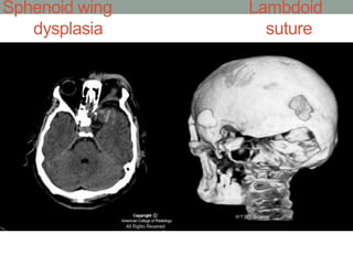 Sphenoid wing Lambdoid
dysplasia suture
defect
 