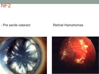 NF2
• Pre senile cataract Retinal Hamartomas
 