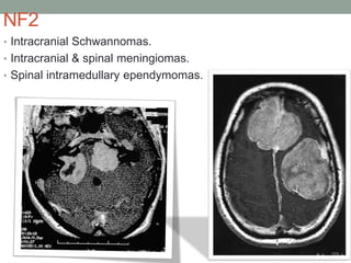 NF2
• Intracranial Schwannomas.
• Intracranial & spinal meningiomas.
• Spinal intramedullary ependymomas.
 