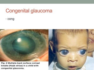 Congenital glaucoma
• cong
 