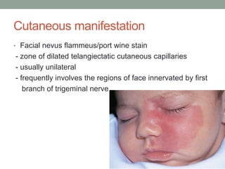 Cutaneous manifestation
• Facial nevus flammeus/port wine stain
- zone of dilated telangiectatic cutaneous capillaries
- usually unilateral
- frequently involves the regions of face innervated by first
branch of trigeminal nerve
 
