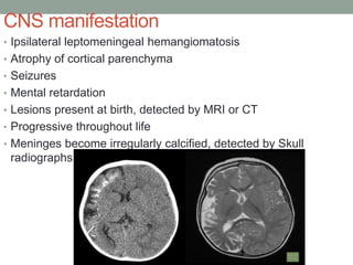 CNS manifestation
• Ipsilateral leptomeningeal hemangiomatosis
• Atrophy of cortical parenchyma
• Seizures
• Mental retardation
• Lesions present at birth, detected by MRI or CT
• Progressive throughout life
• Meninges become irregularly calcified, detected by Skull
radiographs
 