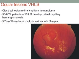 Ocular lesions VHLS
• Classical lesion retinal capillary hemangioma
• 50-60% patients of VHLS develop retinal capillary
hemangiomatosis
• 50% of these have multiple lesions in both eyes
 
