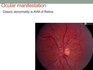 Ocular manifestation
• Classic abnormality is AVM of Retina
 