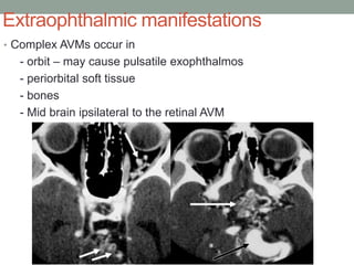 Extraophthalmic manifestations
• Complex AVMs occur in
- orbit – may cause pulsatile exophthalmos
- periorbital soft tissue
- bones
- Mid brain ipsilateral to the retinal AVM
 