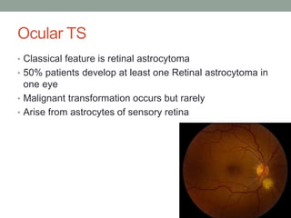 Ocular TS
• Classical feature is retinal astrocytoma
• 50% patients develop at least one Retinal astrocytoma in
one eye
• Malignant transformation occurs but rarely
• Arise from astrocytes of sensory retina
 