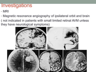 Investigations
• MRI
• Magnetic resonance angiography of ipsilateral orbit and brain
( not indicated in patients with small limited retinal AVM unless
they have neurological symptoms)
 