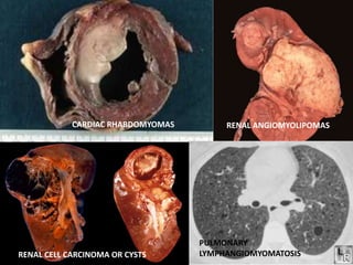 RENAL ANGIOMYOLIPOMAS
CARDIAC RHABDOMYOMAS
PULMONARY
LYMPHANGIOMYOMATOSIS
RENAL CELL CARCINOMA OR CYSTS
 