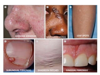 FACIAL ANGIOFIBROMAS
ADENOMA SEBACEUM LEAF SPOTS
SUBUNGUAL FIBROMAS SHAGREEN PATCHES GINGIVAL FIBROMAS
 