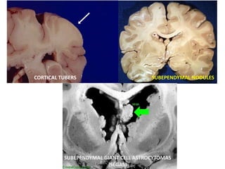 CORTICAL TUBERS SUBEPENDYMAL NODULES
SUBEPENDYMAL GIANT CELL ASTROCYTOMAS
(SEGAS)
 