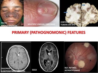 PRIMARY (PATHOGNOMONIC) FEATURES
FACIAL
ANGIOFIBROMAS
MULTIPLE UNGUAL FIBROMAS
CORTICAL
TUBERS ON HPE
CALCIFIED
SUBEPENDYMAL NODULES
M/L RETINAL
ASTROCYTOMAS
SEGA
 