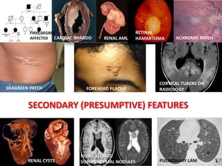 SECONDARY (PRESUMPTIVE) FEATURES
FIRST DEGREE
AFFECTED CARDIAC RHABDO
RETINAL
HAMARTOMA ACHROMIC PATCH
RENAL AML
SHAGREEN PATCH FOREHEAD PLAQUE
CORTICAL TUBERS ON
RADIOLOGY
RENAL CYSTS
NON-CALCIFIED
SUBEPENDYMAL NODULES PULMONARY LAM
 